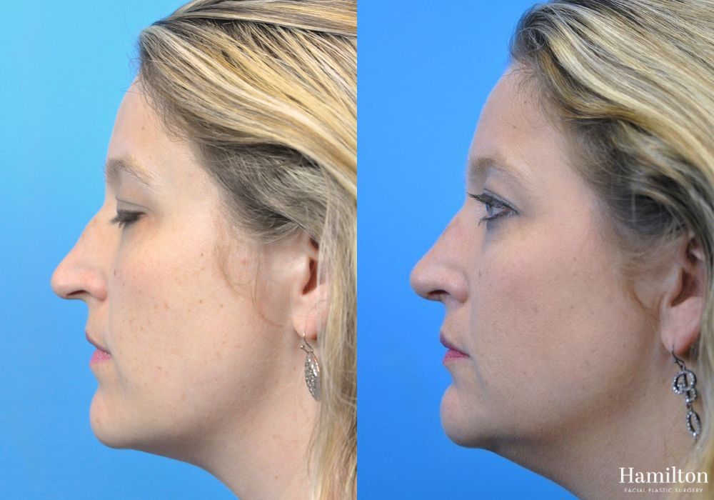 Before and after Rhinoplasty case 37330