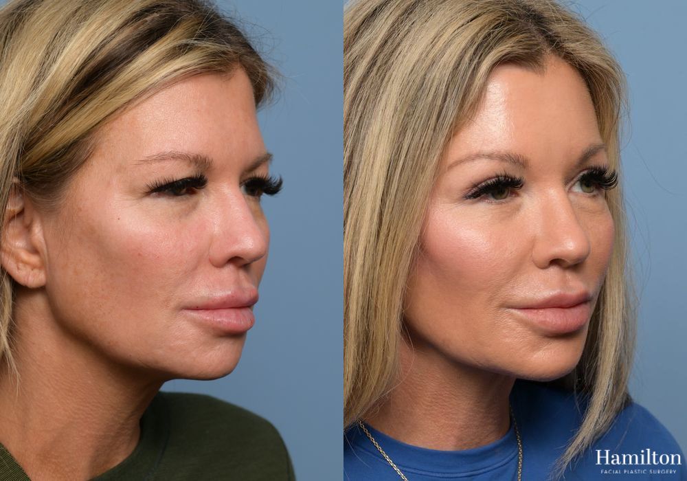 Before and after Brow Lift case 37111 - Angle 3