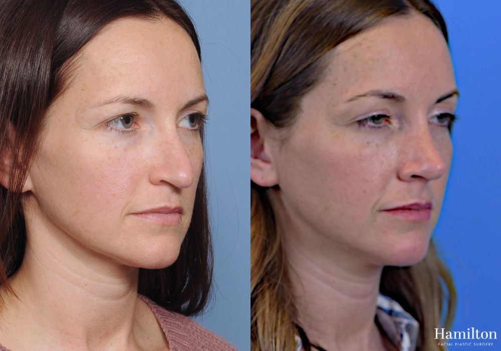 Before and after Rhinoplasty case 37199 - Angle 2