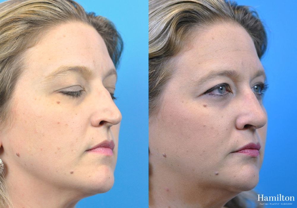 Before and after Rhinoplasty case 37330 - Angle 3