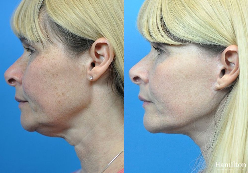 Before and after Facelift case 37261 - Angle 4