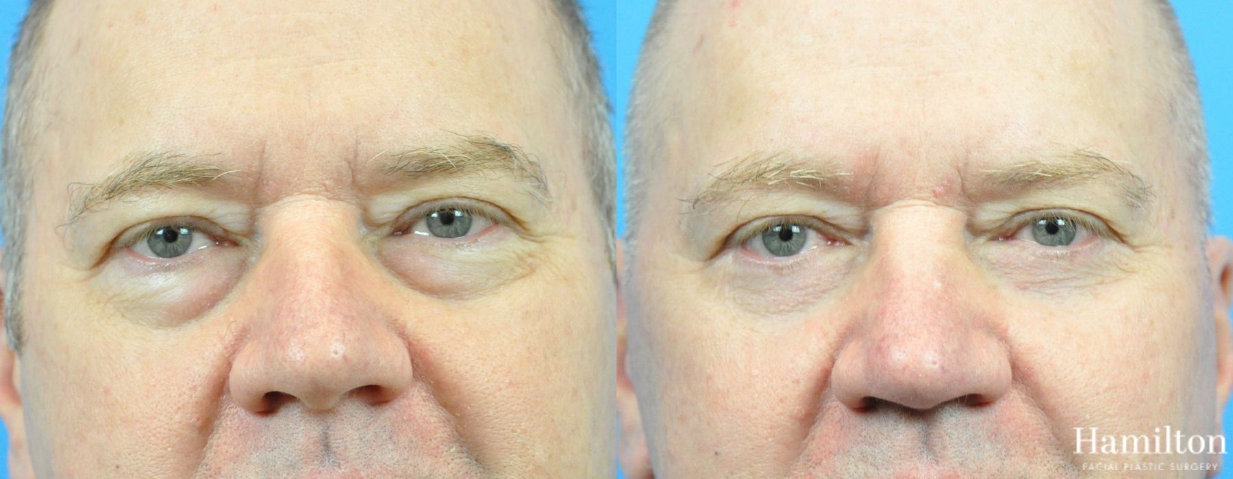 Before and after Blepharoplasty case 37282