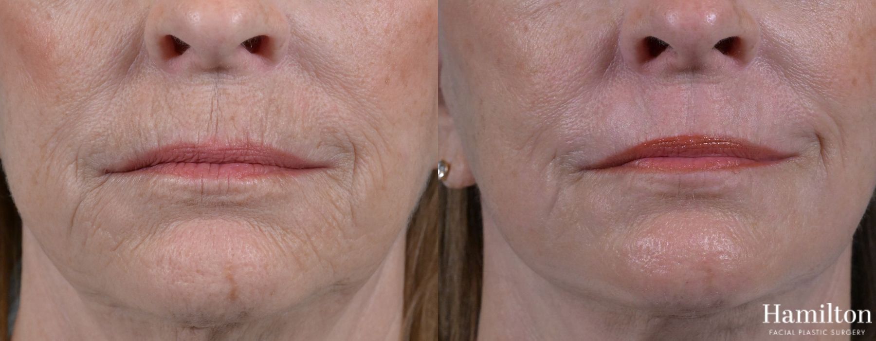 Before and after Laser - Sciton case 37118 - Angle 2