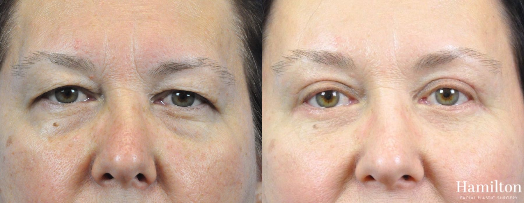 Before and after Blepharoplasty case 37308