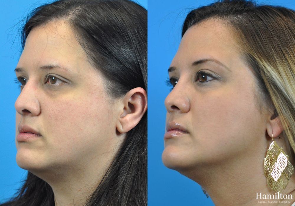 Before and after Rhinoplasty case 37327 - Angle 4