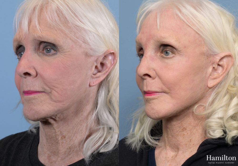 Before and after Laser - CO2 case 37166