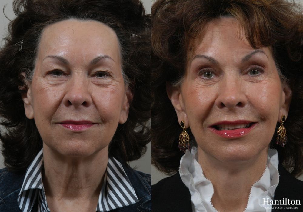 Before and after Facelift case 37326