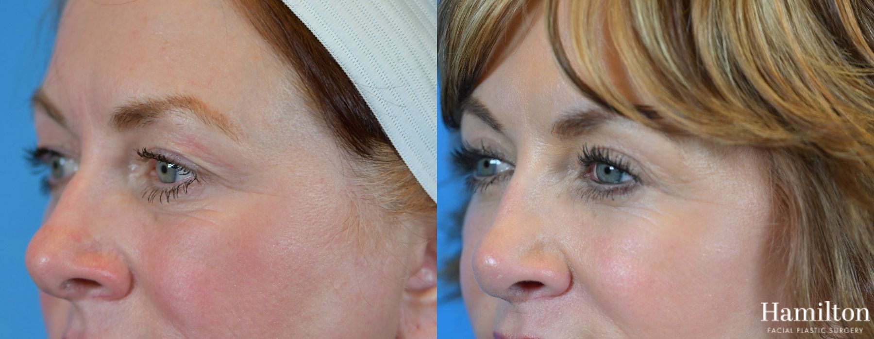 Before and after Blepharoplasty case 37277 - Angle 4