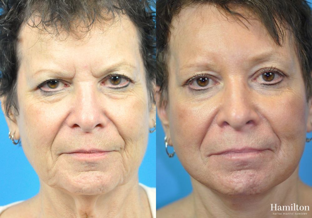 Before and after Brow Lift case 37232