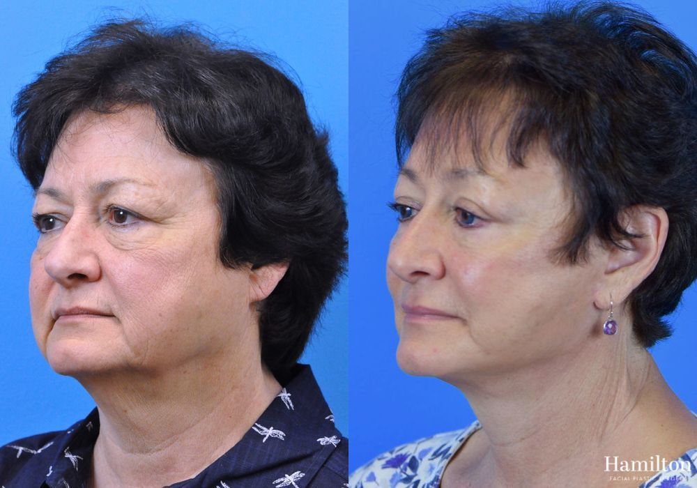Before and after Facelift case 37296 - Angle 4