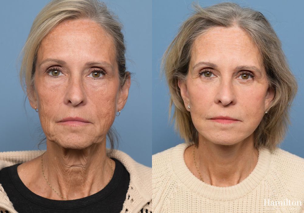 Before and after Fat Grafting case 37098