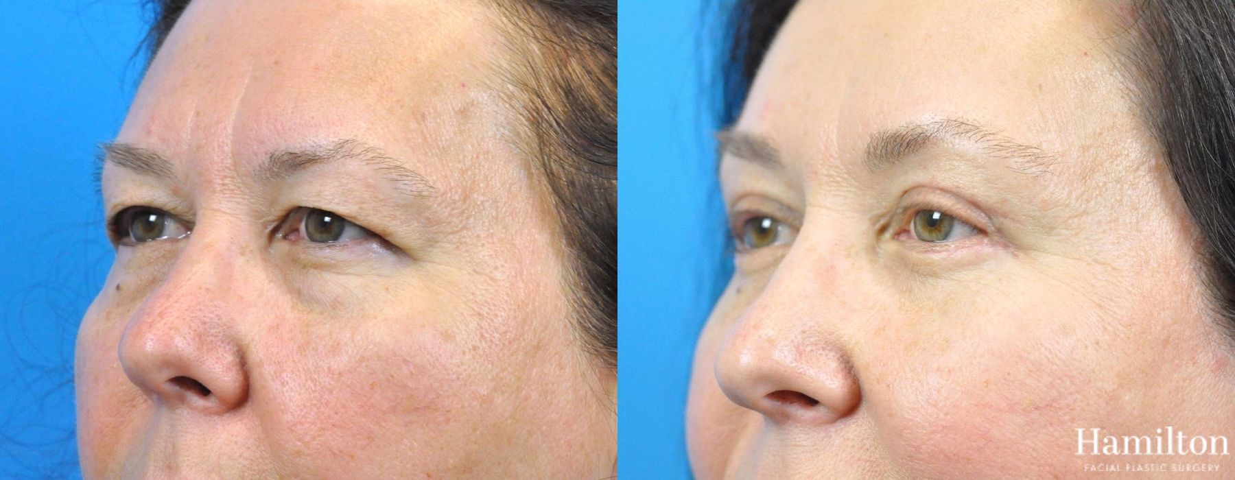 Before and after Blepharoplasty case 37308 - Angle 4