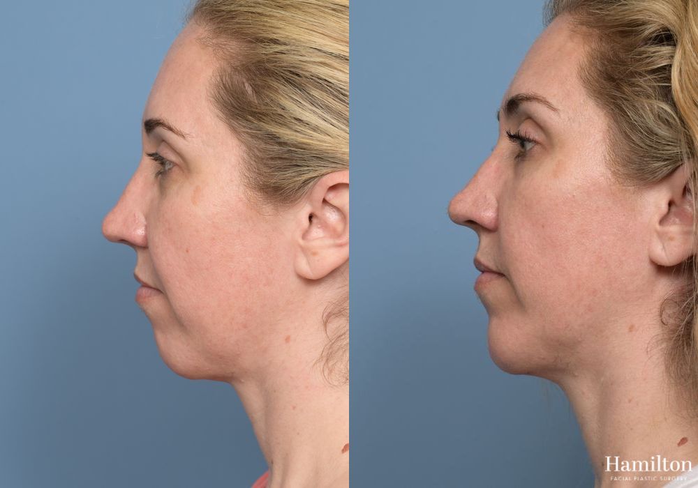 Before and after Chin Augmentation case 37179