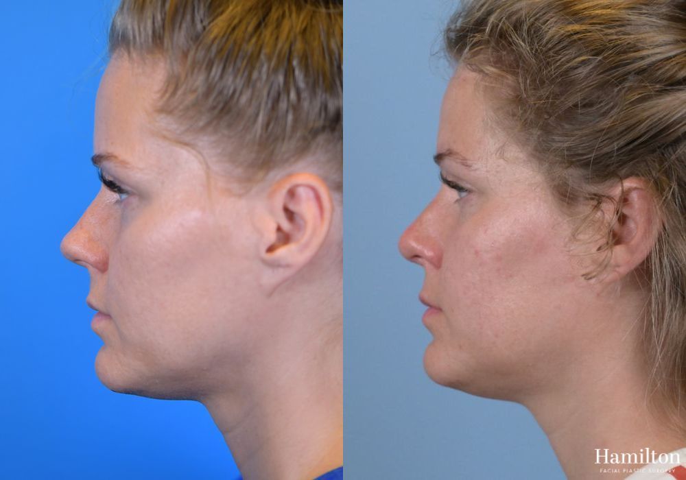 Before and after Rhinoplasty case 37359 - Angle 4