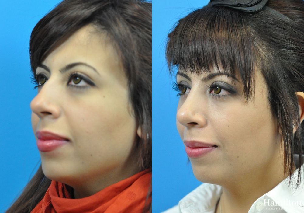 Before and after Rhinoplasty case 37268
