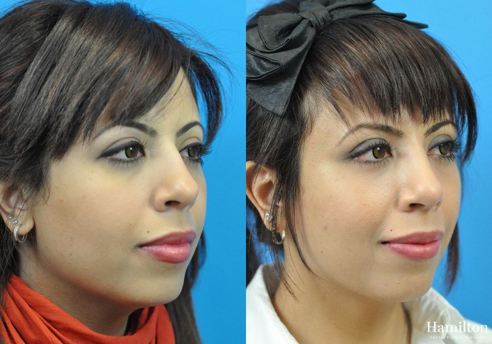 Before and after Rhinoplasty case 37268 - Angle 4