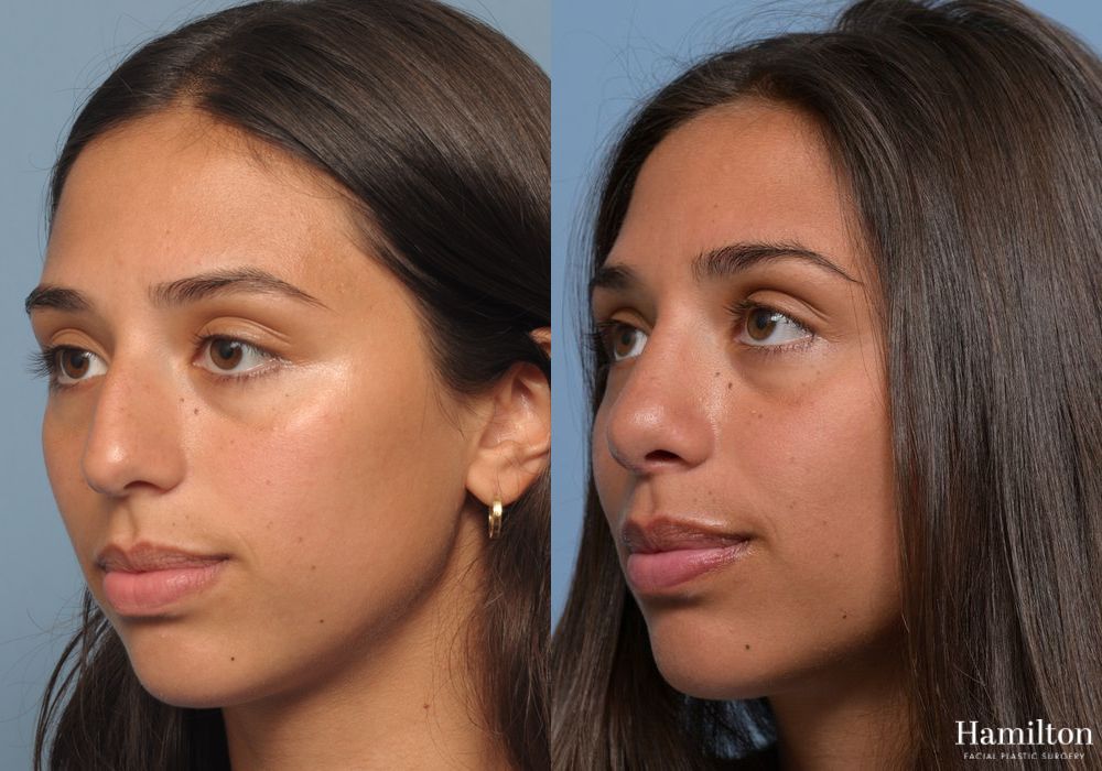 Before and after Rhinoplasty case 37177 - Angle 3