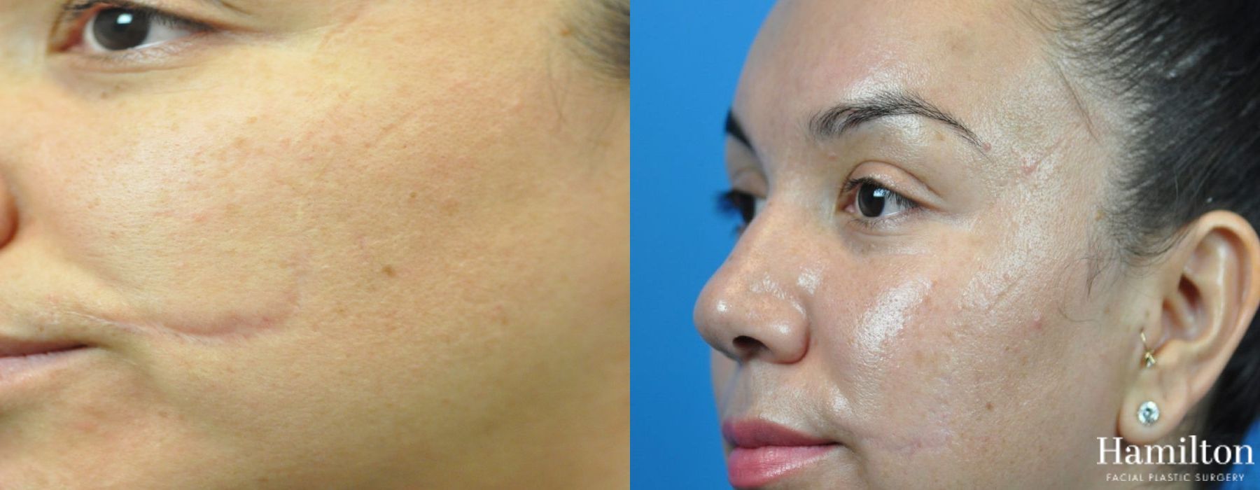 Before and after Scar Revision case 37342 - Angle 2