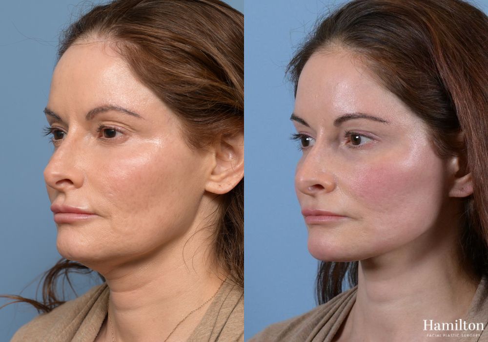 Before and after Neck Rejuvenation case 37096 - Angle 4