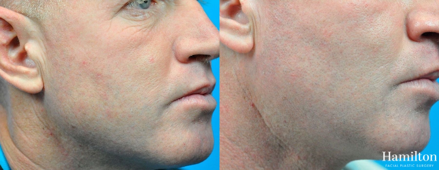 Before and after Laser - Fractional Resurfacing case 37344 - Angle 3