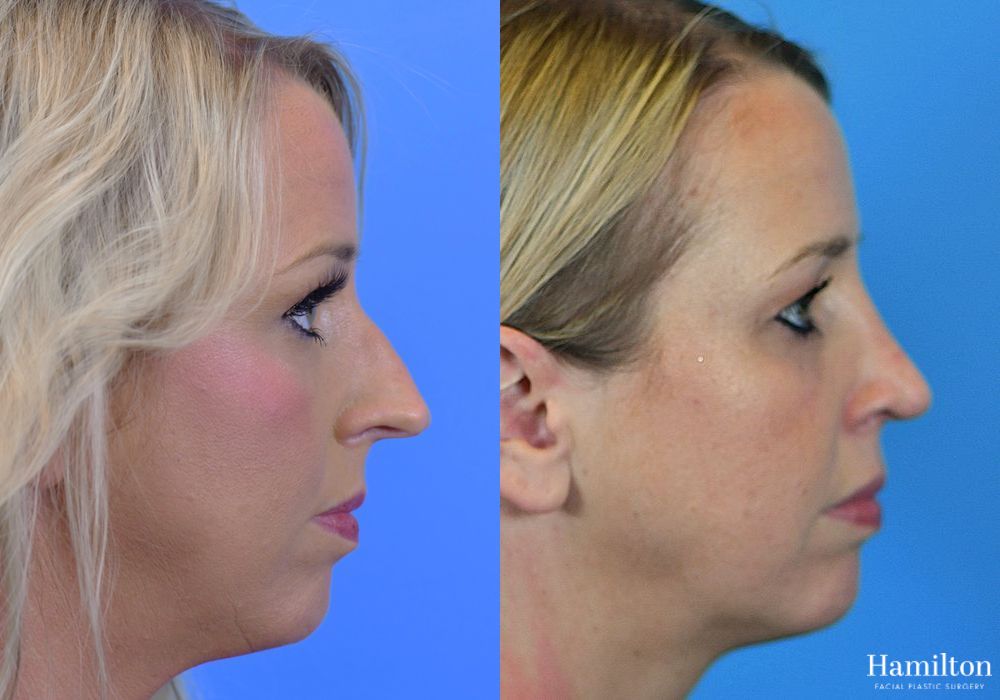Before and after Rhinoplasty case 37259 - Angle 5