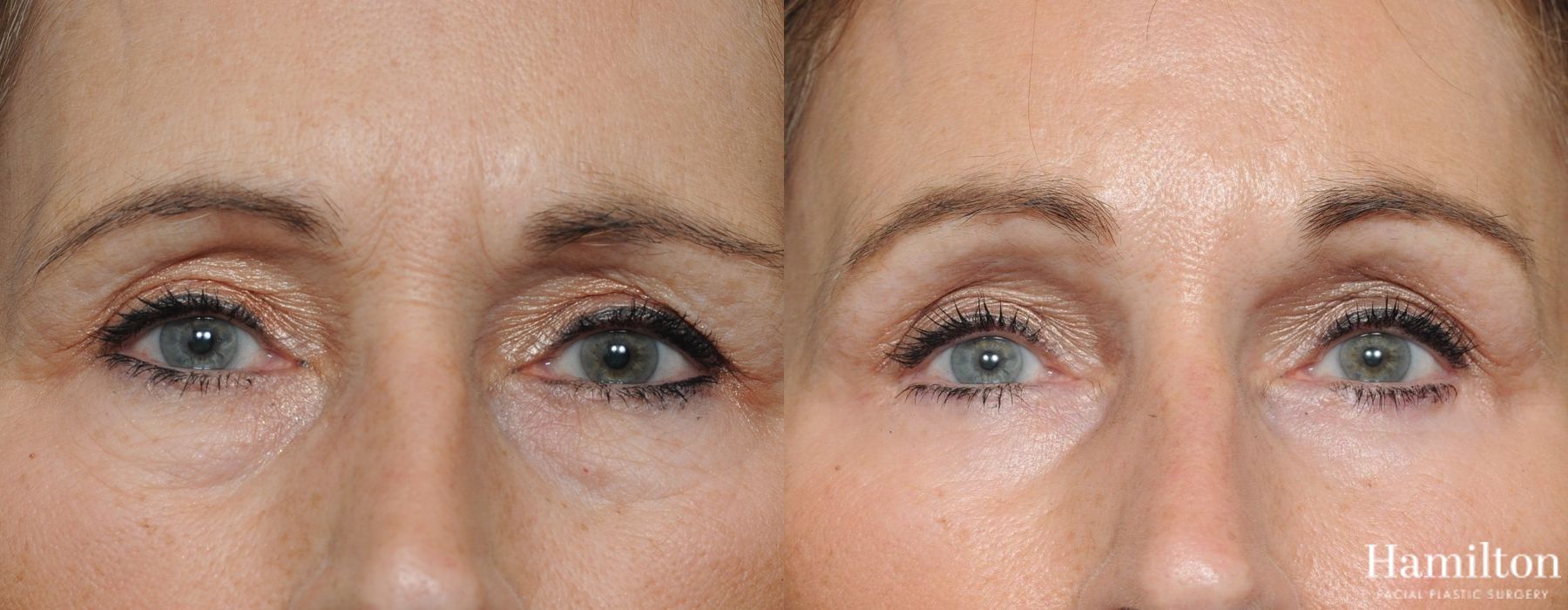 Before and after Blepharoplasty case 37263 - Angle 2