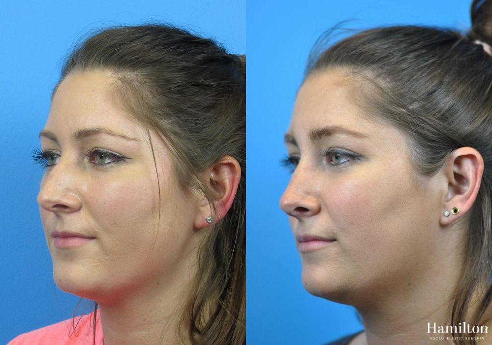 Before and after Rhinoplasty case 37313 - Angle 3