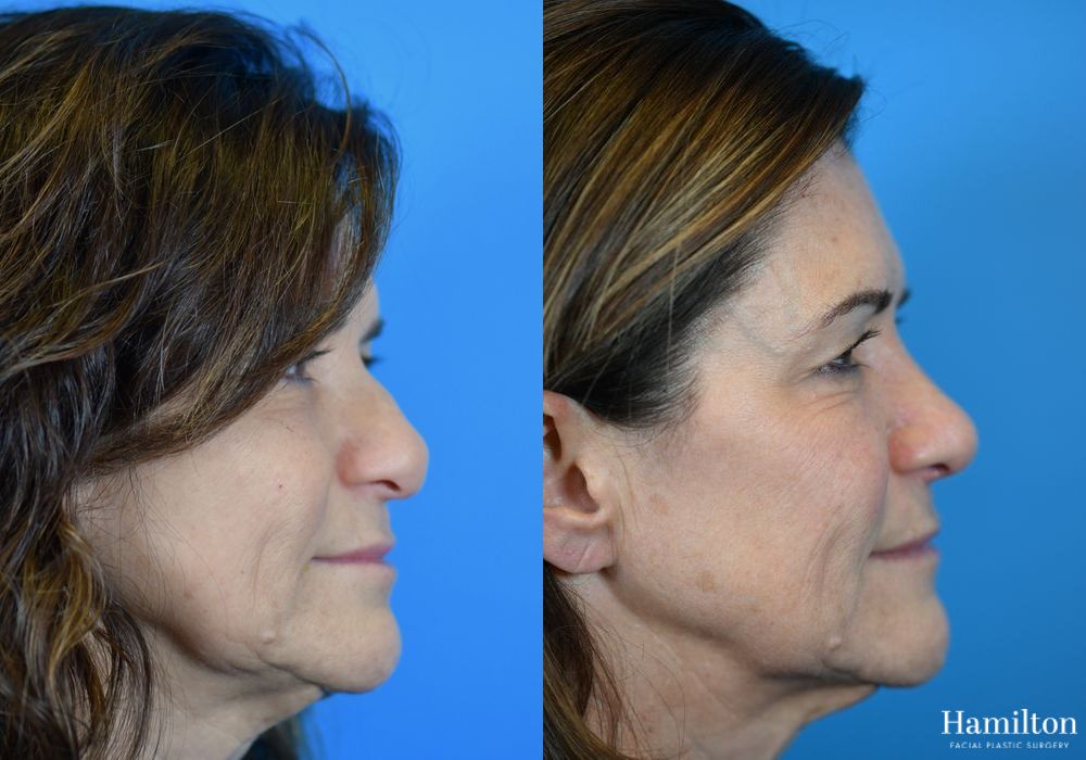 Before and after Rhinoplasty case 37299 - Angle 5