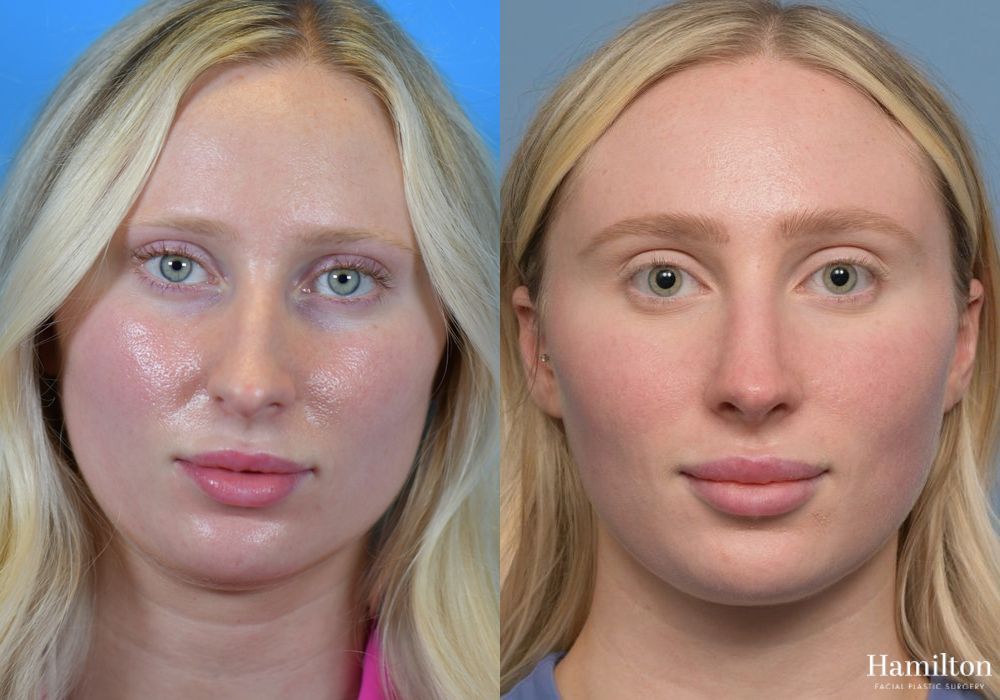 Before and after Rhinoplasty case 37157 - Angle 5
