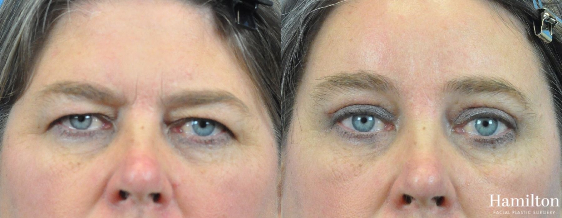Before and after Blepharoplasty case 37272