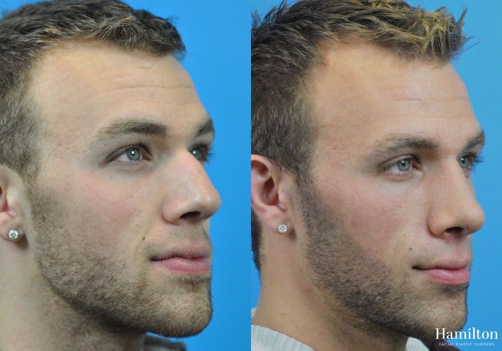 Before and after Rhinoplasty case 37250 - Angle 3