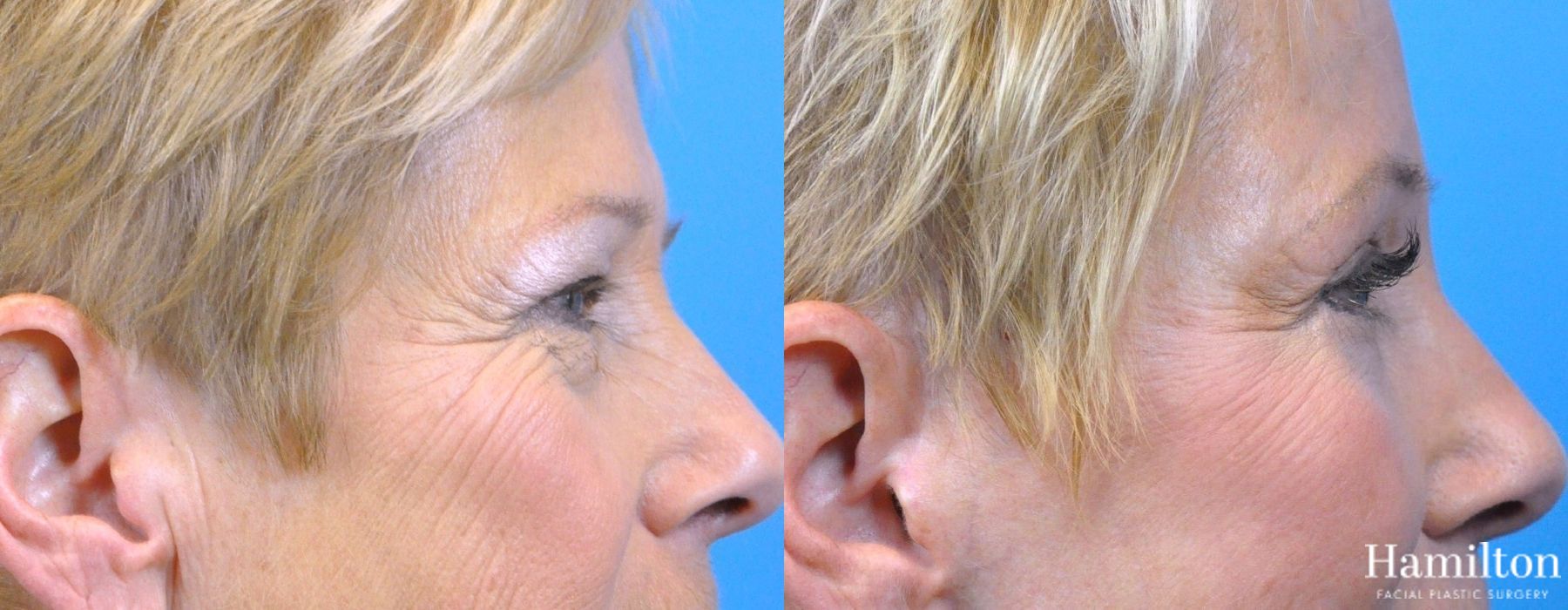 Before and after Blepharoplasty case 37088 - Angle 4