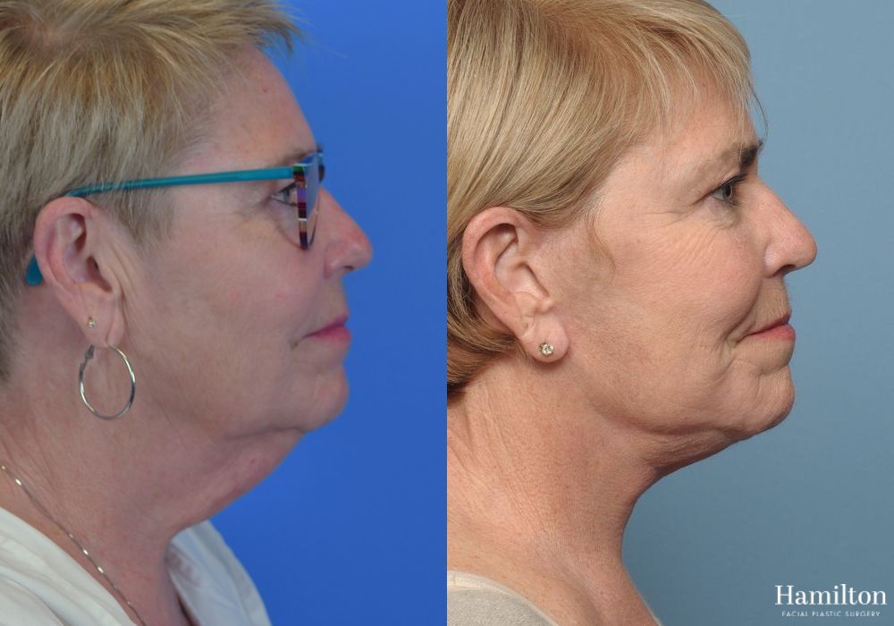 Before and after Facelift case 37290 - Angle 2
