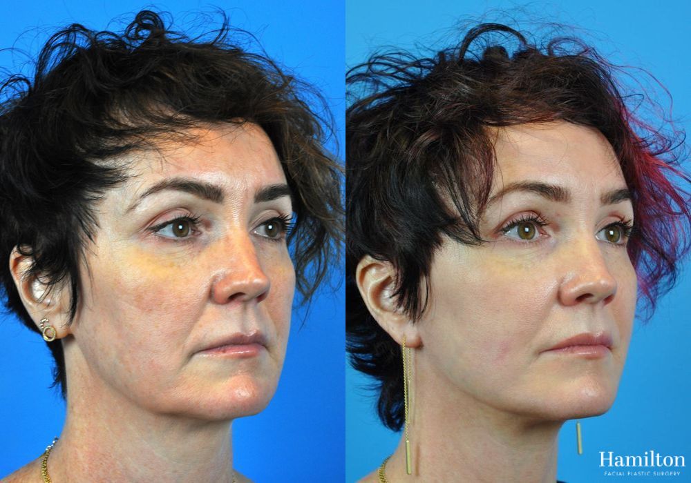 Before and after Mini Facelift case 37095 - Angle 3