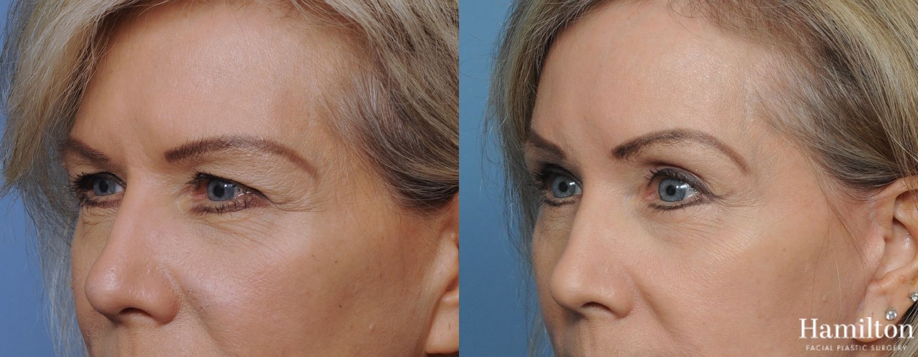 Before and after Blepharoplasty case 37253 - Angle 2