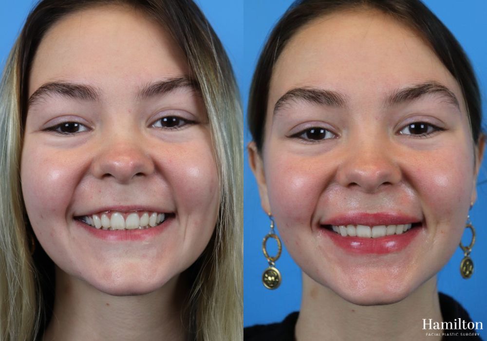 Before and after Fillers case 37084