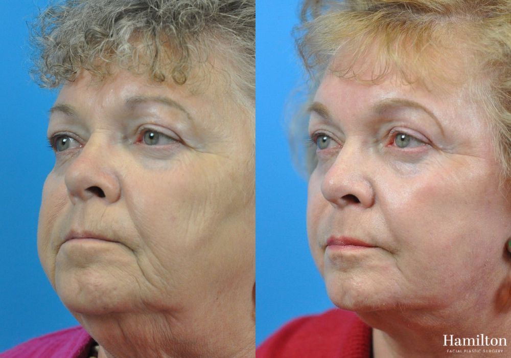 Before and after Laser - CO2 case 37210 - Angle 3