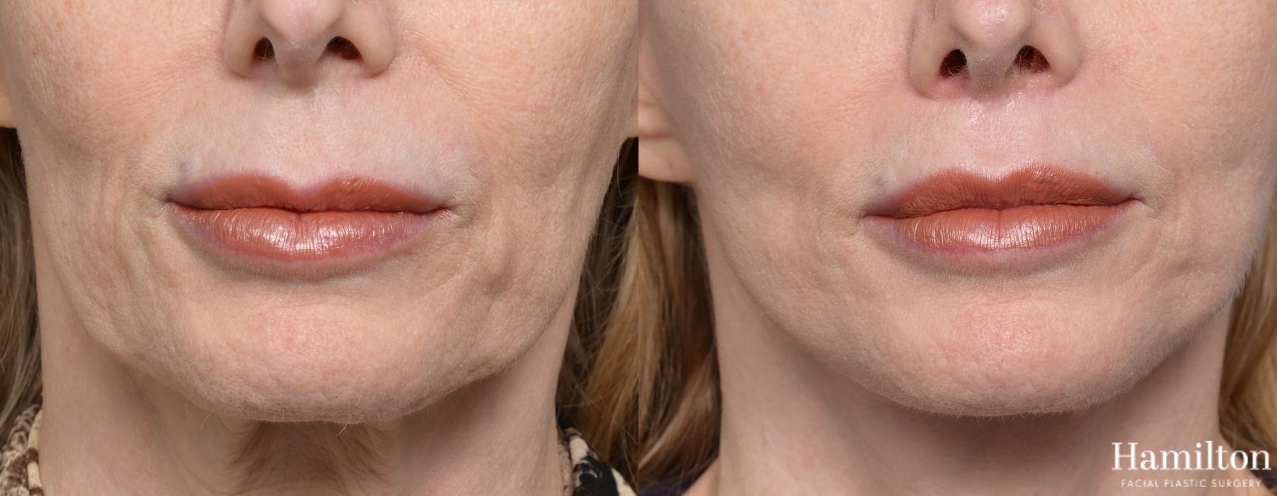 Before and after Lip Lift case 37100 - Angle 2