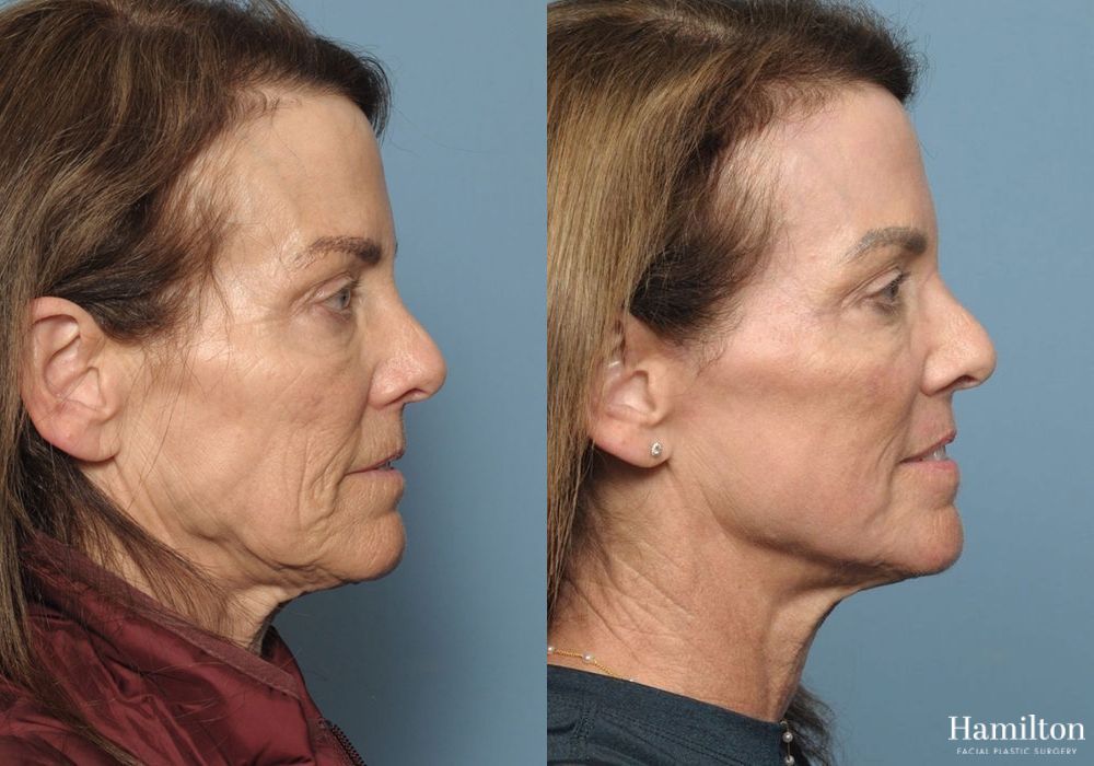 Before and after Laser - CO2 case 37150 - Angle 5