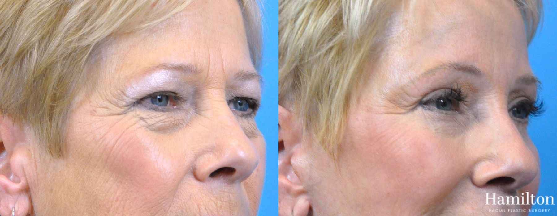 Before and after Blepharoplasty case 37088 - Angle 3