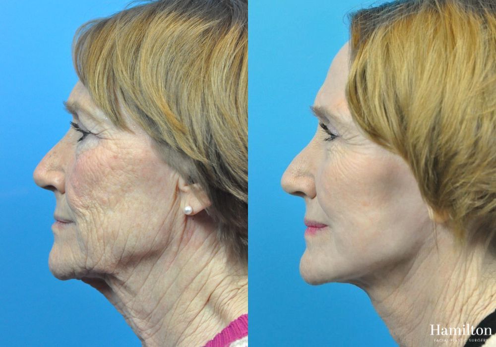 Before and after Laser - CO2 case 37231