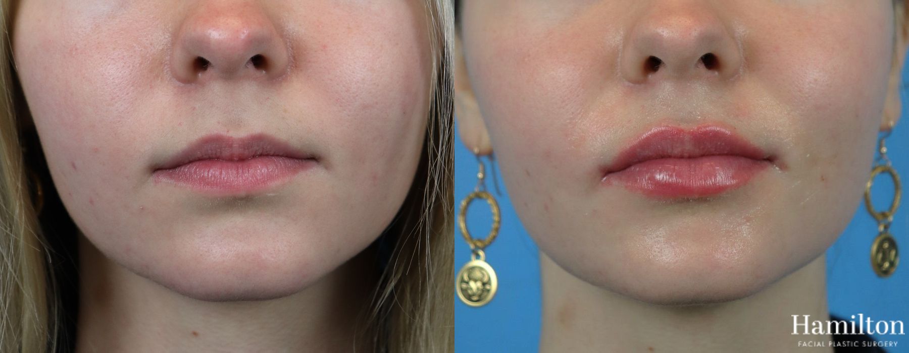 Before and after Fillers case 37084 - Angle 2