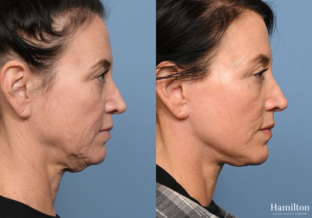 Before and after Facelift case 37315 - Angle 2