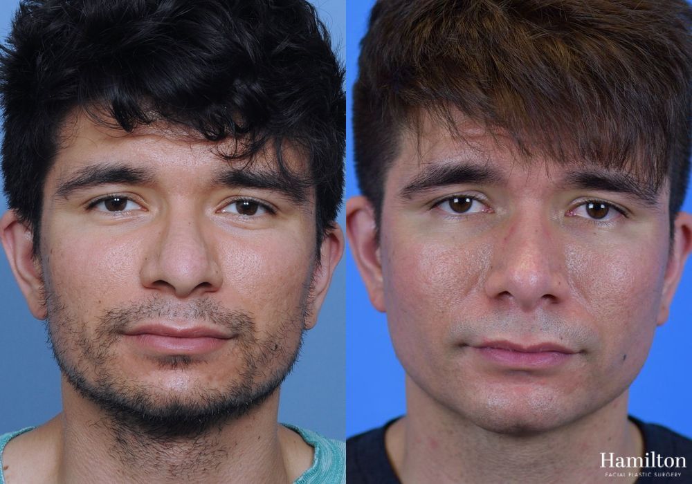 Before and after Rhinoplasty case 37271 - Angle 3