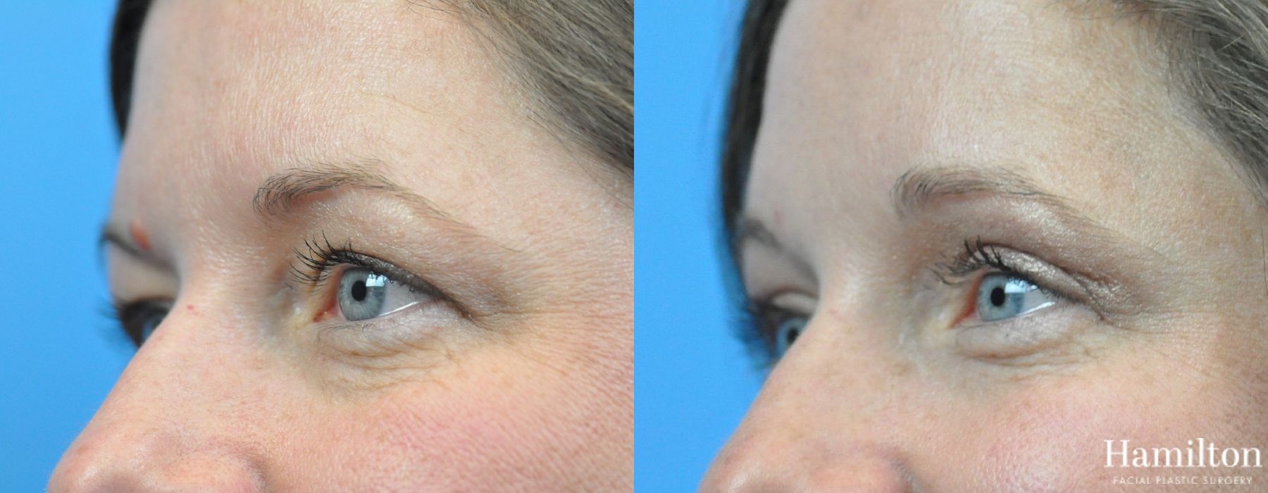 Before and after Blepharoplasty case 37307 - Angle 4
