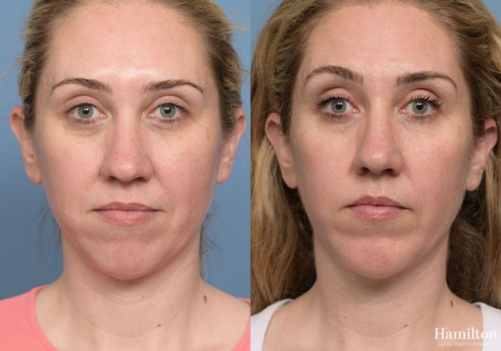 Before and after Chin Augmentation case 37179 - Angle 5