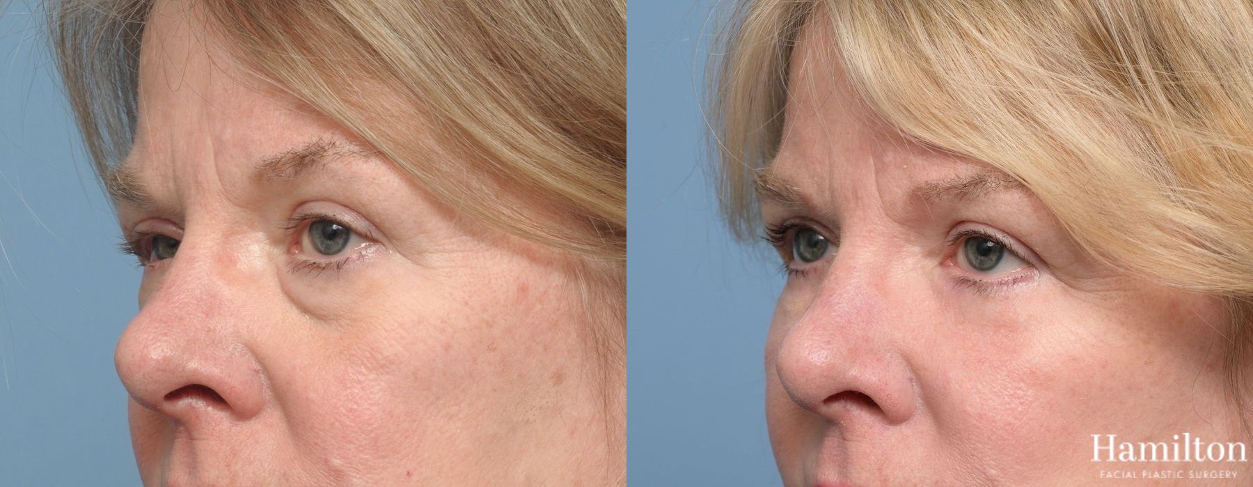 Before and after Blepharoplasty case 37230 - Angle 3