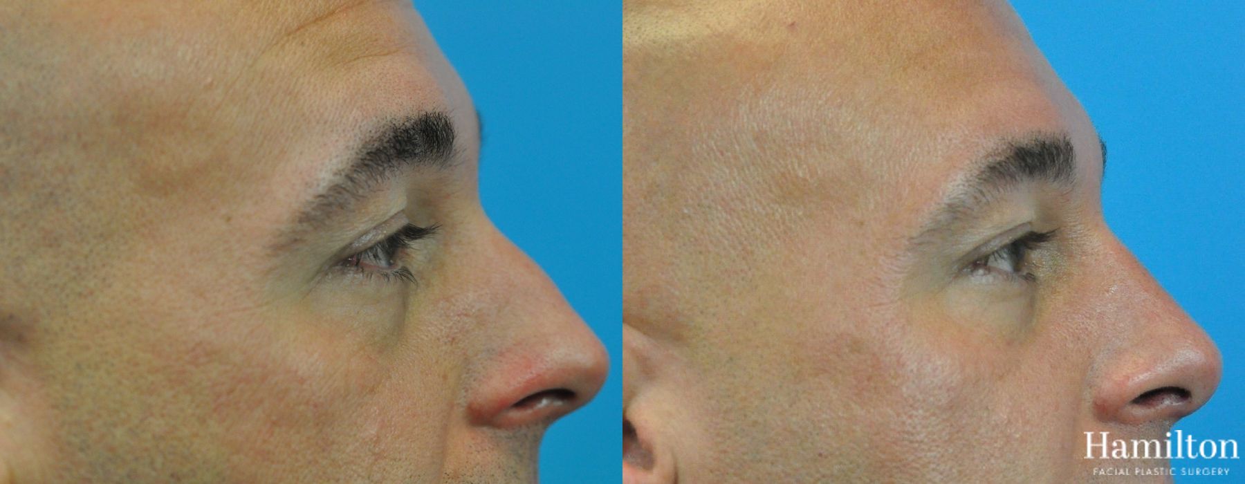 Before and after Rhinoplasty case 37255 - Angle 2