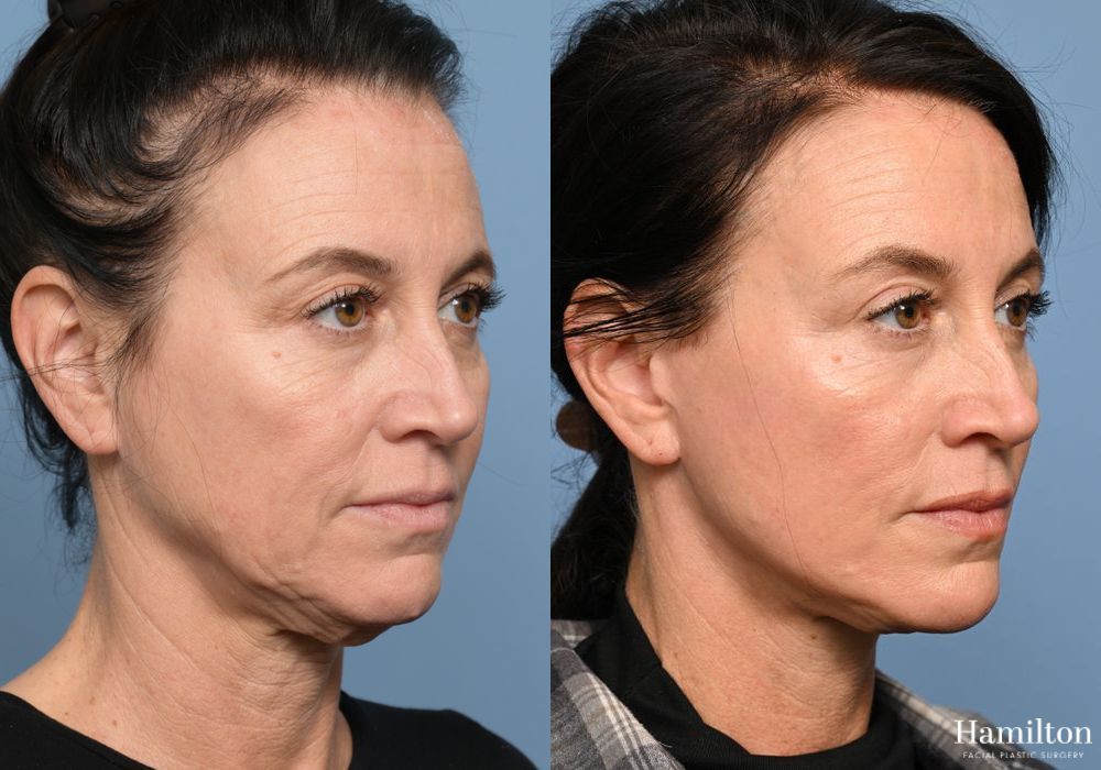 Before and after Facelift case 37315 - Angle 3