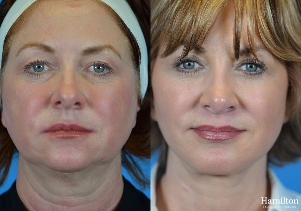 Before and after Rhinoplasty case 37318 - Angle 5